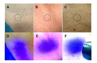 Prospective evaluation of patient-reported outcomes of invisible ink tattoos for the delivery of external beam radiation therapy: the PREFER trial